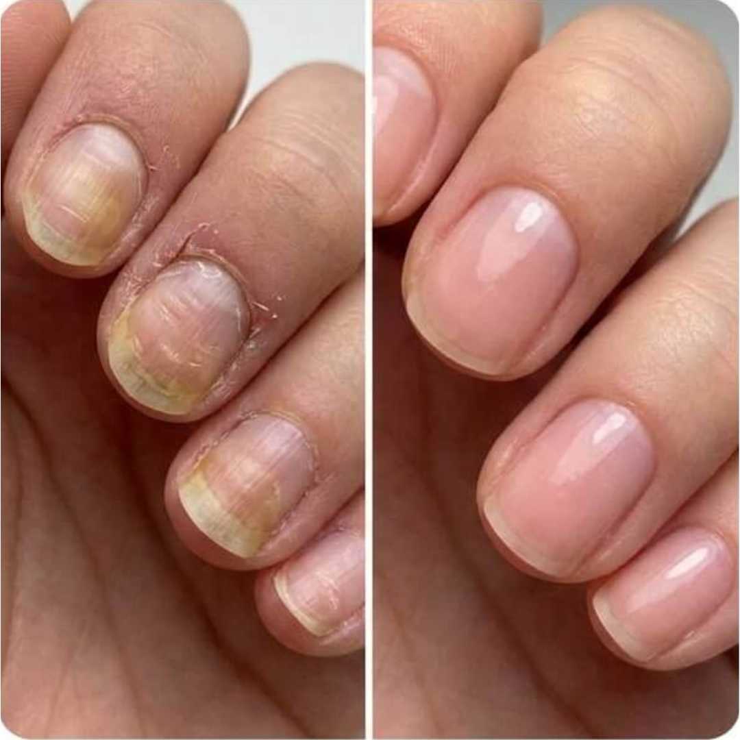 7Days Elimina Hongos - Cuida de tu uñas ya !!