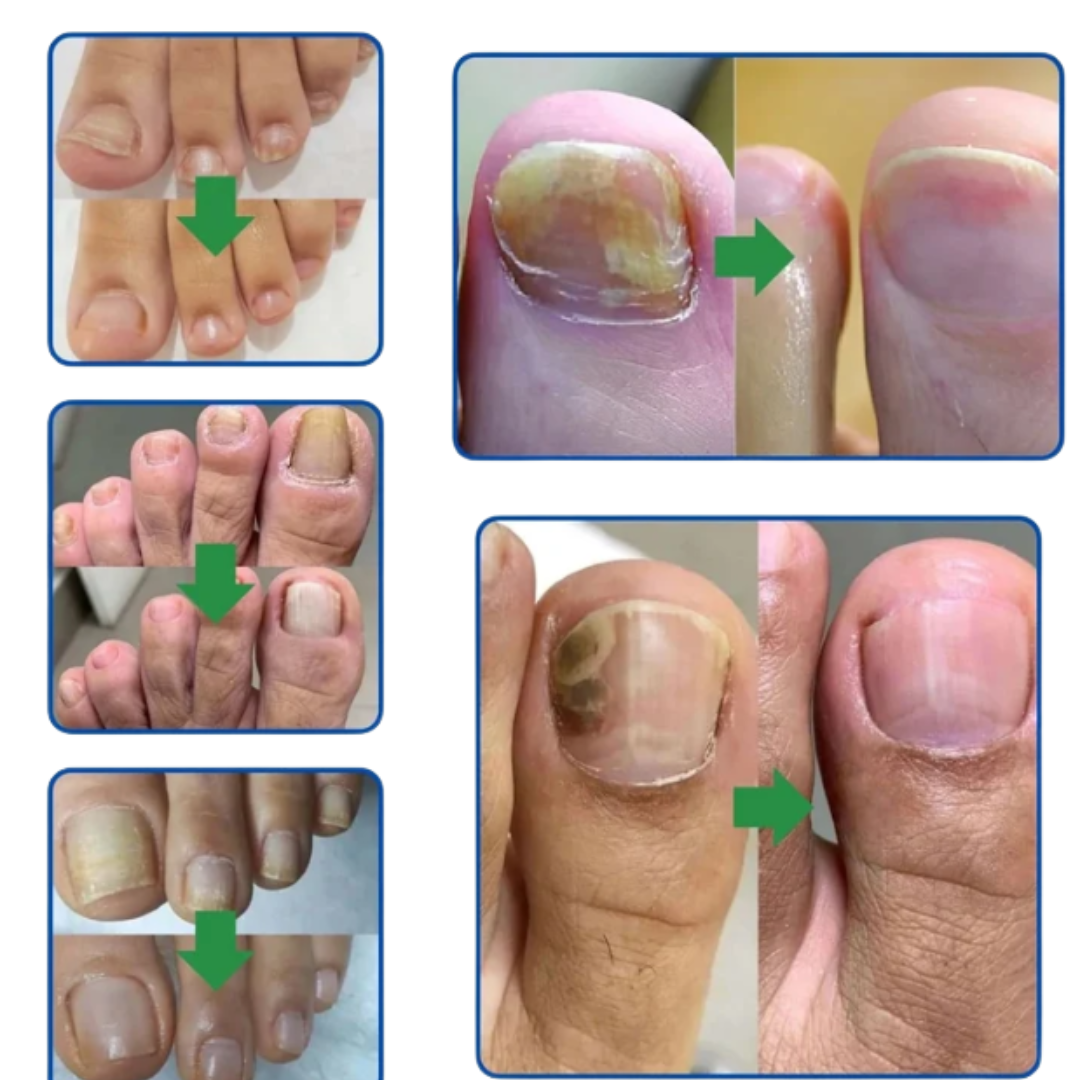 Fungus 7 dias Deja de esconder tus uñas y dales el cuidado que merecen.