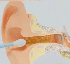 Limpieza de oídos inteligente con tecnología avanzada – WaxClean™